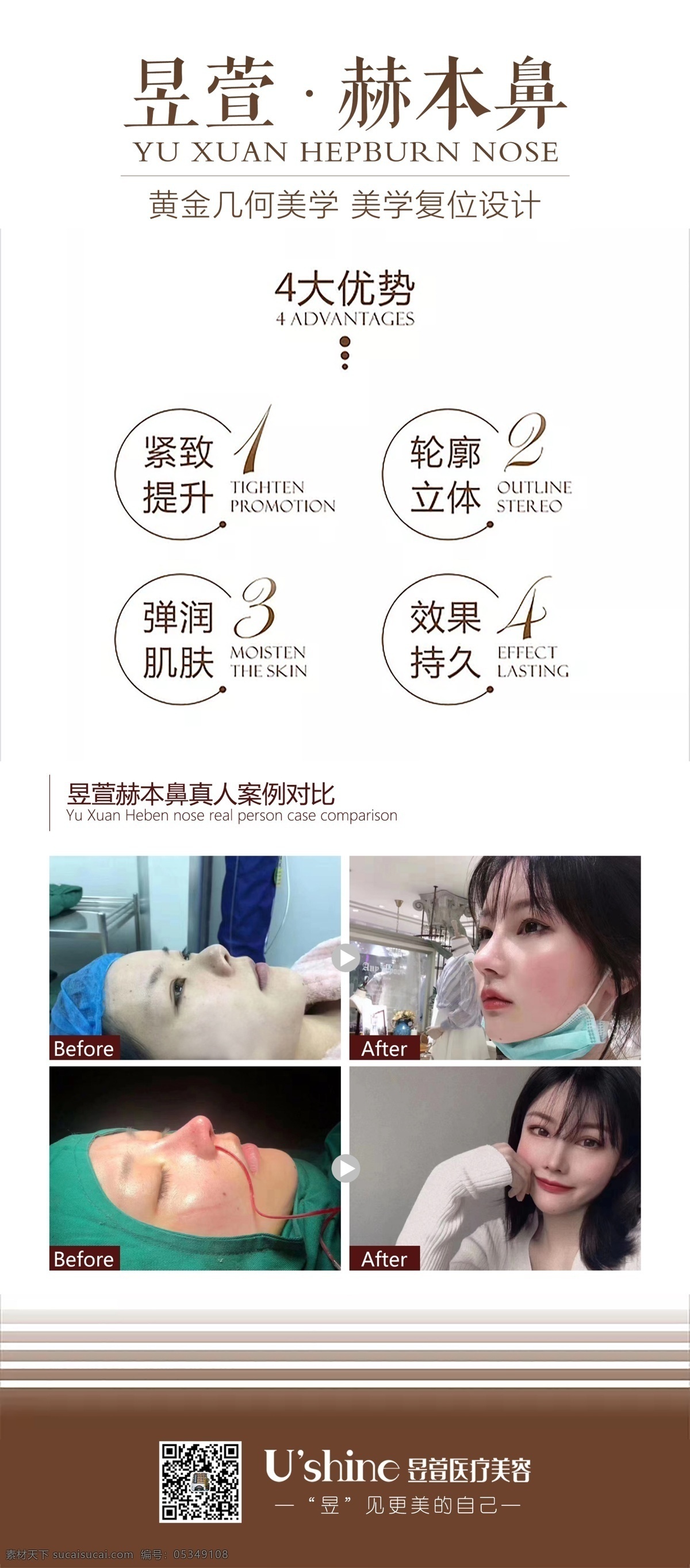 醫(yī) 美 整形 醫(yī)院 案例 對(duì)比 海報(bào) 醫(yī)美 整形醫(yī)院 案例對(duì)比 鼻子 術(shù)后