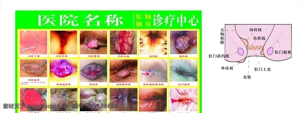 肛肠 典型 病症 图解 解剖 图 腋臭 解剖图 内痔 外痔 混合痔 肛瘘 肛门 痔疮 痔 矢量