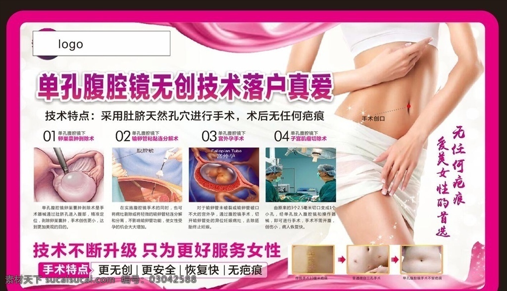 单孔 腹腔镜 妇科 广告 技术
