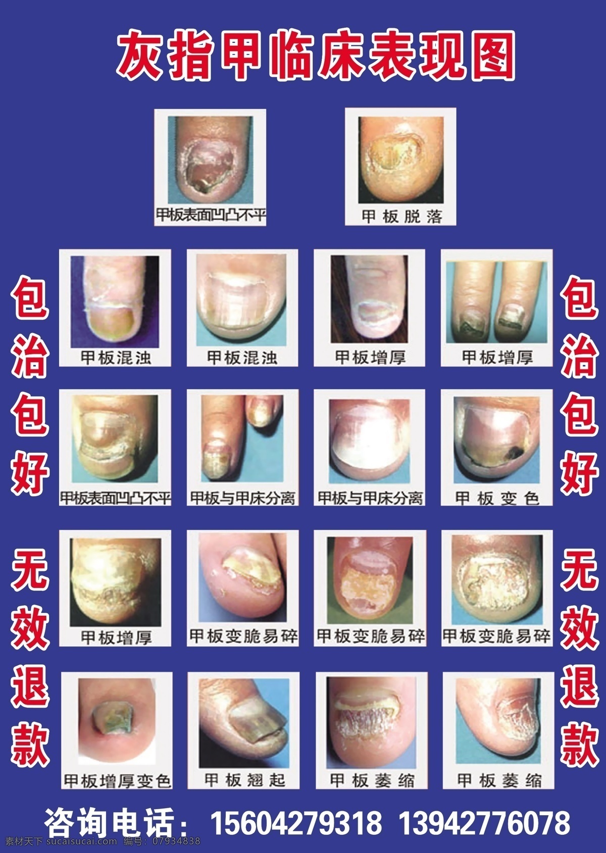 灰指甲 甲沟炎 脚病 腱鞘炎 钳甲 分层