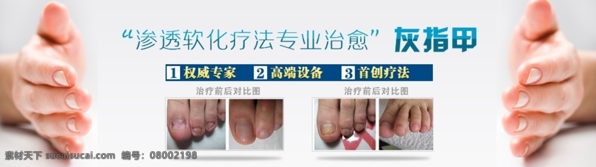 灰指甲 治疗 技术 医疗 皮肤病 白色 案例图 医院 疗法 中文模版 网页模板 源文件