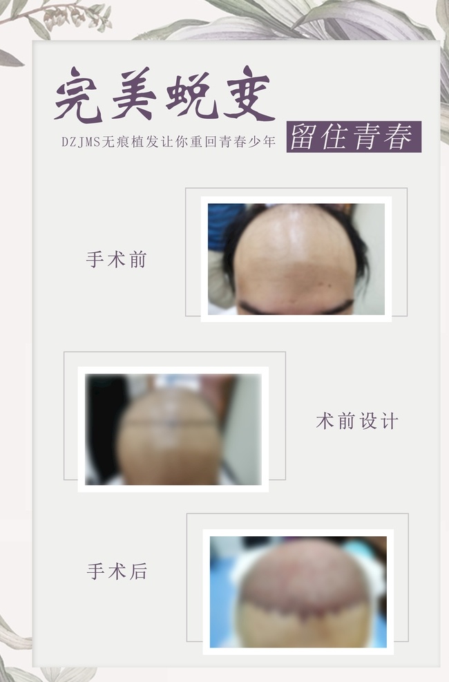 植发广告 植发案例广告 植发对比图 种植头发 植发海报 植发案例 医美海报 美容海报 头等大事 植得托付 医美 海报