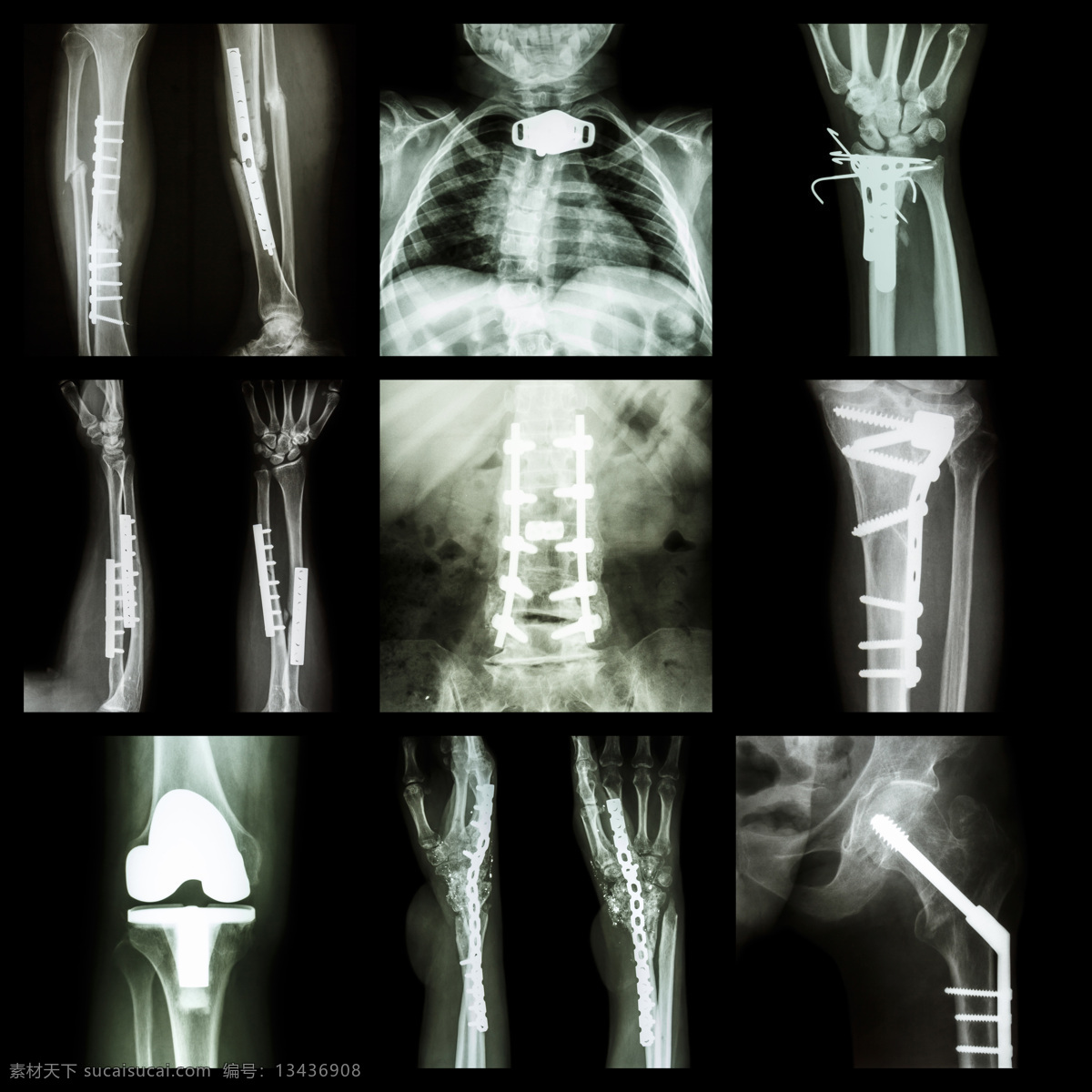 人体x光片 人体 x光 透视 医疗 ct x光片 核磁共振 医疗护理 现代科技