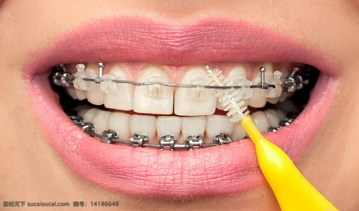 牙齿美容 正畸 牙齿 牙科 美容 钢丝 现代科技 医疗护理